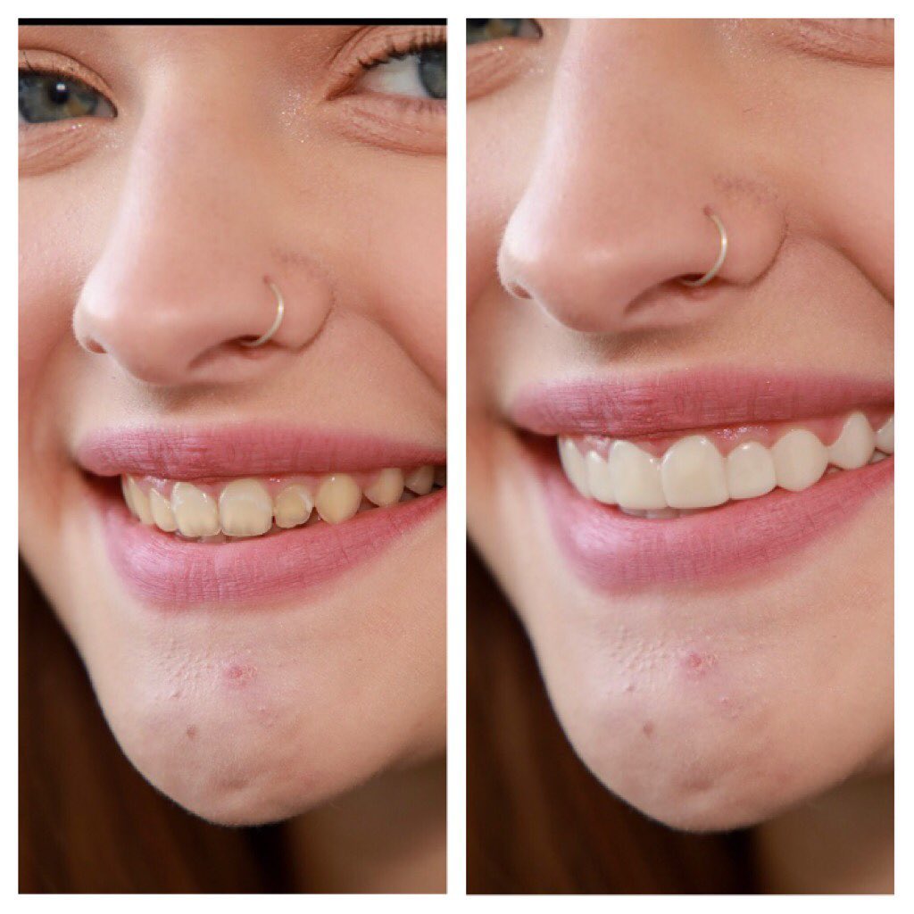 Verified 15% Off | Shiny Smile Veneers Discount Code & Promo Codes