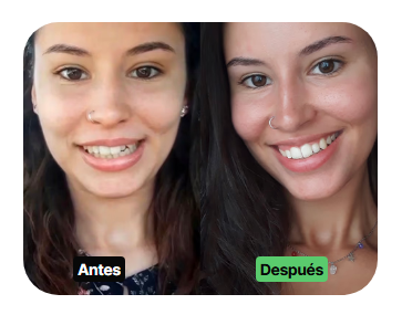 foto de la web de DrSmile de ejemplo de tratamiento de DrSmile